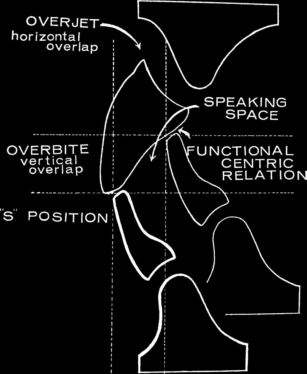 THE JOURNAL OF PROSTHETIC DENTISTRY POUND Fig. 1. Diagram showing distal position on lower lip of upper anterior teeth when F and V sounds are produced.