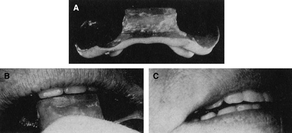 POUND THE JOURNAL OF PROSTHETIC DENTISTRY Fig. 3. A, Stabilized lower base with speaking wax in place. It is advisable not to have an occlusion rim that will create any interferences during speech.