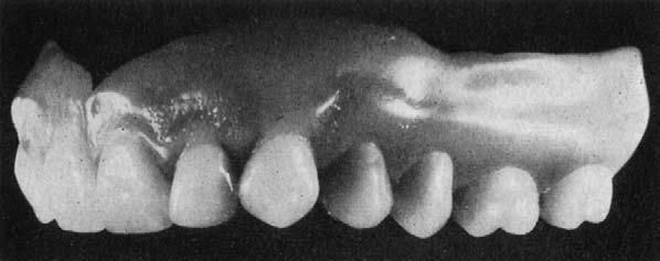 Any abrasion on the buccal surfaces of these teeth or on the higher lingual walls of the fossae indicates that there is a side shift of the mandible, which should be eliminated.