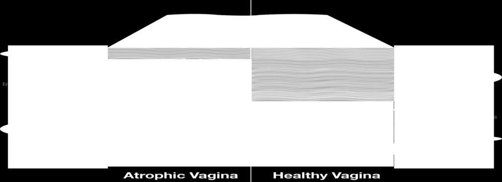 Statistical changes in vaginal ph from basic to acidic (decrease ph) 3.
