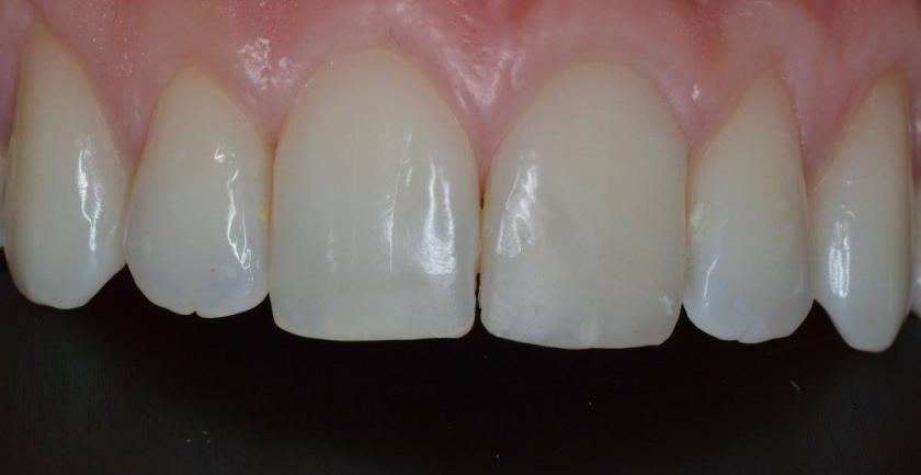 The composite resins provide satisfactory treatments results for even young and adult patients, but it is indicated to adults when the volume, length or number of composite restorations is limited.
