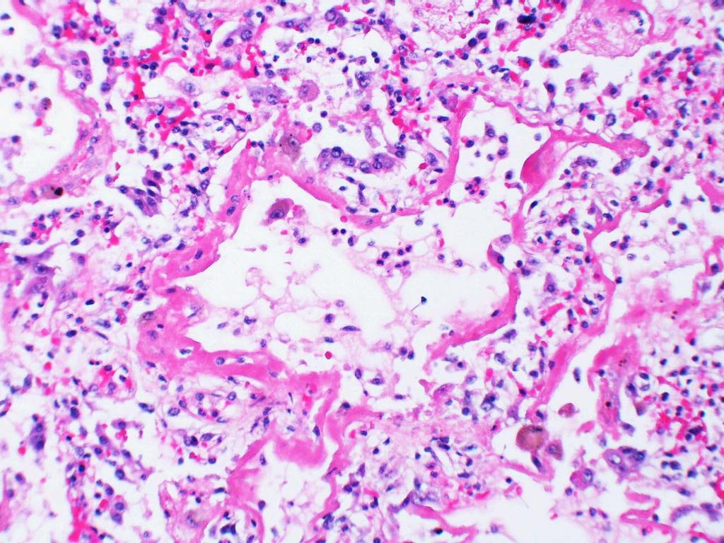 Pathophysiology: Stages Diffuse Alveolar Damage Acute exudative phase (7-14 days) Hyaline membranes Necrosis of alveolar epithelial cells