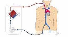 Refractory Hypoxemia: Extracorporeal Membrane Oxygenation Salvage therapy for ARDS Directly oxygenates and removes carbon dioxide from blood Blood withdrawn from central vein ECMO circuit via pump
