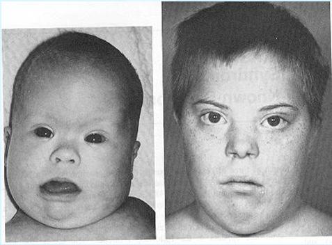 Phenotype of Down Syndrome