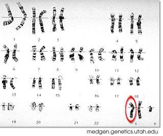 Chromosomal Disorders In males, nondisjunction may cause Klinefelter s syndrome, resulting from the inheritance of an extra X chromosome, which interferes with meiosis and usually prevents these
