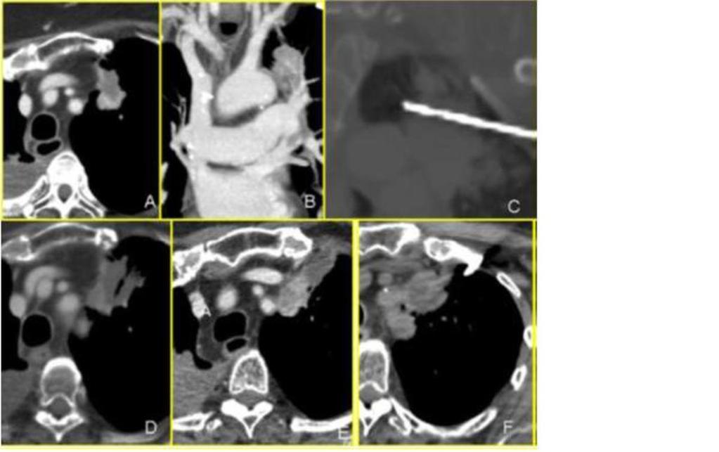 Fig. 2: A)CT-scan performed before the treatment: primary lung cancer (arrow); B) CTscan shows the antenna (arrow head) placed across the tumour; C) CT-scan reveals cavitation (star) of the lesion