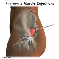 Anatomy What parts of the body are involved? To perform a piriformis muscle injection, your doctor inserts a needle into the piriformis muscle.