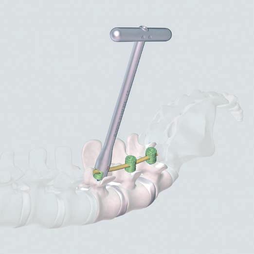 2. Head without rod Apply the Stop Sleeve over the polyaxial head. Then apply the Remobilizing Instrument as described before.