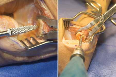 OPENING RADIAL CANAL 11 Starting with the smallest Rasp, position the hand in pronation and insert the Rasp past the tuberosity in