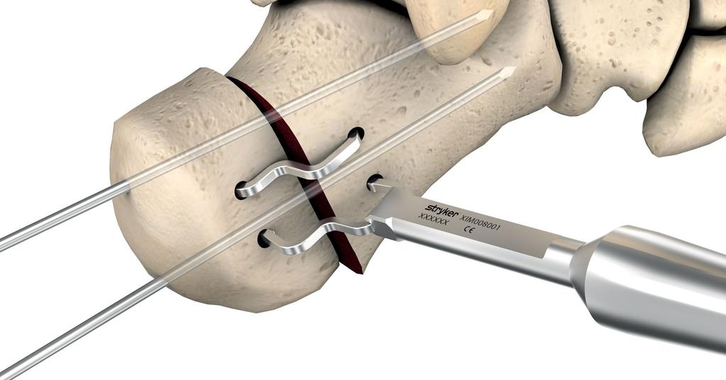 7. Implant impaction Impact the implant with the impactor (XIM008001) and a mallet until the staple back is in contact with the bone surfaces (Fig. 12). Figure 12 8.