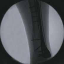 fixation under fluoroscopic image guidance in