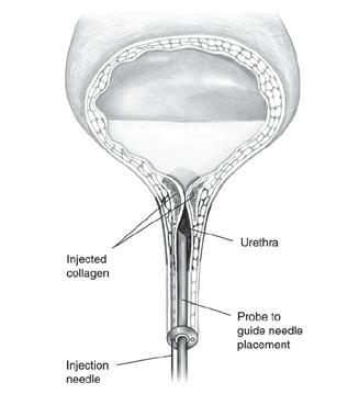 Artificial sphincter When the man uses the pump, the fluid in the balloon is transferred to the urethra cuff of the artificial sphincter. This closes the urethra and prevents leakage of urine.