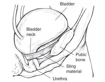 Results may vary in men who have had radiation treatment, other bladder conditions or who have scar tissue in the urethra. A sling may also be offered as a treatment option for men with SUI.