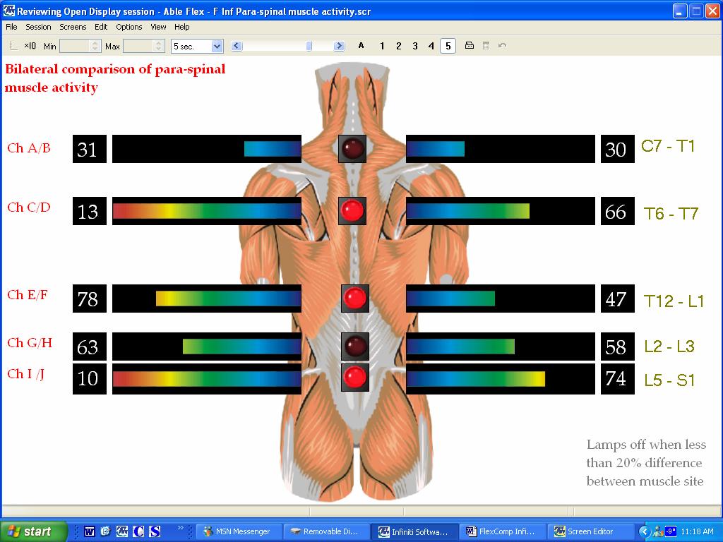 F Inf Para-spinal muscle activity.scr Channel Set: F Inf 10 Ch EMG Bi-Lateral Differences.chs Category: Difference Description: Bilateral comparison of para-spinal muscle activity.