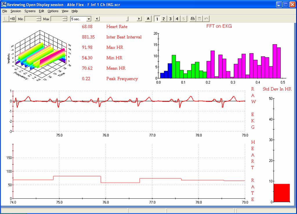 F Inf 1 Ch EKG.scr Channel Set: F Inf 5 Ch Multi Modality.chs Category: Multi Modality Description: EKG Overview of Signals.