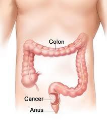 FACTS ABOUT COLON CANCER Am I at risk for colon cancer? Everyone is at risk for colon cancer.