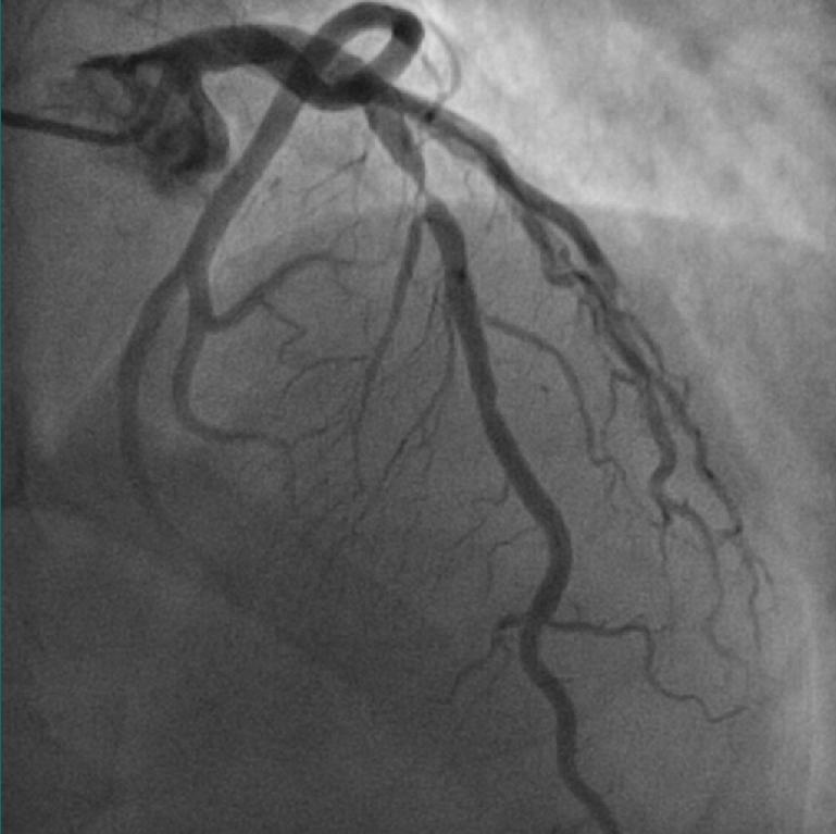 - 160 mm axial scanning with - 100 kv and 270 ma - 75% acquisition peak - BMI: 25 - ASiR-V 1 to lower dose Curved - LAD 3D Coronary Tree SPECT Hybrid Coronary angiogram - 0.