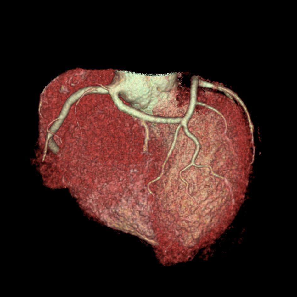 Fran Mikulicic This congenital anomaly of the left coronary artery reveals a joint origin of the LMA and RCA from the right