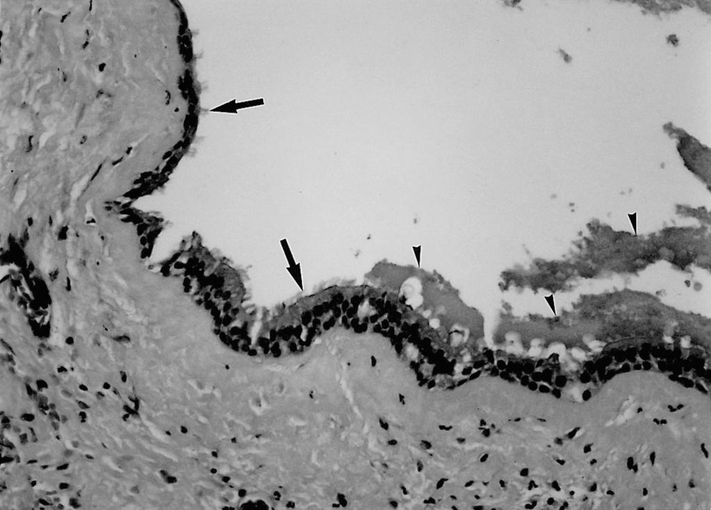 TGD usually contains thick, gelatinous mucoid fluid, and microscopically, may be lined with transitional, cuboidal, columnar or stratified squamous epithelium, and this may be ciliated or nonciliated.