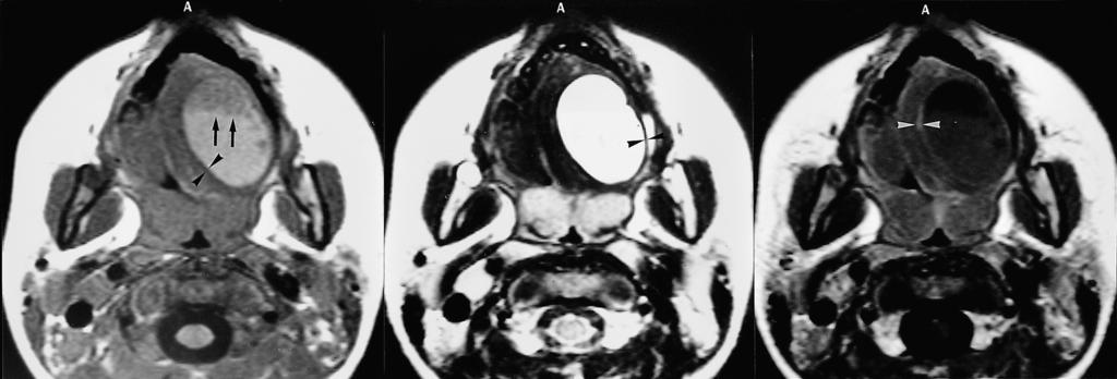 Kim et al. within the tumor is unusual. MR imaging of an epidermoid cyst typically depicts a cystic mass, hypointense on T1-weighted images and hyperintense on T2-weighted images (Fig. 4).