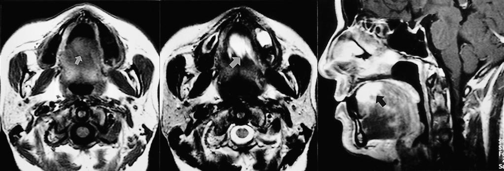 Radiologic-Pathologic orrelation of Unusual ongenital Lingual Masses Fig. 5. Venous malformation in a 35-year-old female with a bluish tongue mass.