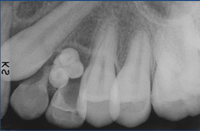 neoplasm Consists of varying amounts of dentin, enamel, cementum,