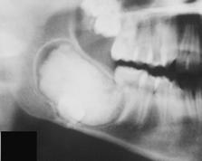 Posterior jaws (mandible or maxilla) X ray: irregular mass of