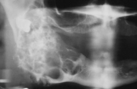 Ameloblastoma Treatment Lesion is infiltrative and extends beyond