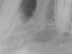 apparent radiographic margin Radiographic features of malignancy