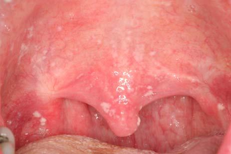 plaques that wipe off) Erythematous (dorsal tongue atrophy, red patch on hard palate, denture stomatitis) Angular cheilitis (cracking and