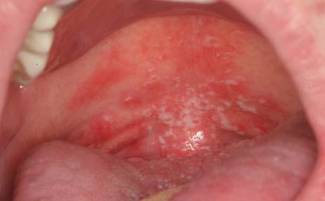 Candidiasis Also known as thrush White adherent plaques that can be scraped off Underlying mucosa is normal or slightly red Mild or no symptoms
