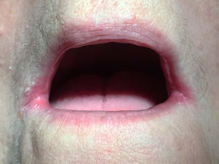 Angular cheilitis Erythema, cracking, and fissuring at the corners of the mouth Can occur in anyone, but especially in patients