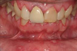 (vesicles, followed by crusting of the lip vermillion and perioral skin) Recurrent