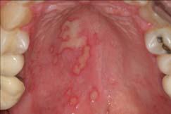 Herpes labialis Also known as cold sores or fever blisters Numerous potential