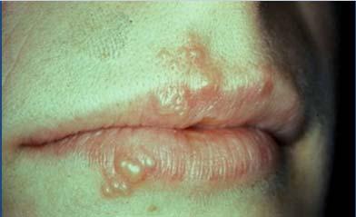 prodrome 6 24 hours before clinical lesions develop Pain, burning, tingling,