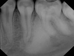 and 1 st molar area Asymptomatic, no expansion Idiopathic osteosclerosis Radiographic appearance Homogeneous radiopacity Well