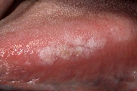 Pigmented Oral Lesions Indications for biopsy Located on hard palate or maxillary gingiva (most common sites for oral