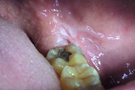 Differential diagnosis Frictional keratosis Morsicatio (cheek or lip chewing) Contact stomatitis Hyperplastic candidiasis