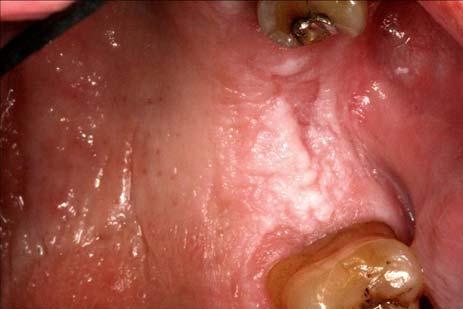 callous of the oral mucosa Margins blend into surrounding mucosa Reversible upon elimination of the cause Common locations