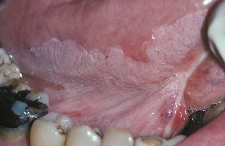 Leukoplakia An adherent white patch or plaque that cannot be characterized clinically as any other