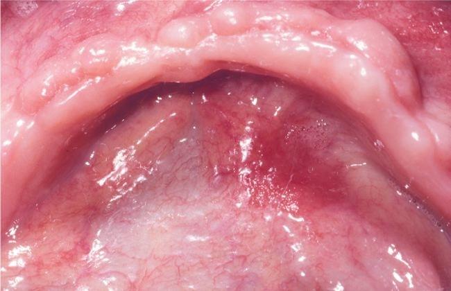 Erythroplakia A red patch that cannot be characterized clinically as any other disease A less common precancerous oral
