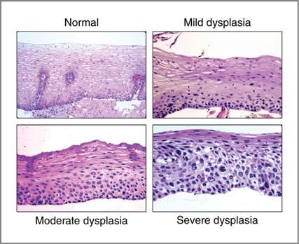 Severe epithelial dysplasia Epithelial dysplasia Atypical cellular changes (see next slide) The closer to the surface