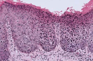 to basilar ½ of the epithelial thickness Severe = extends beyond ½ of the epithelial thickness, but not full thickness