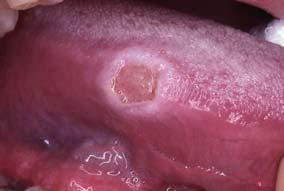 Ulcers: Many potential causes Traumatic Immune mediated Aphthous ulcers, erosive lichen planus,