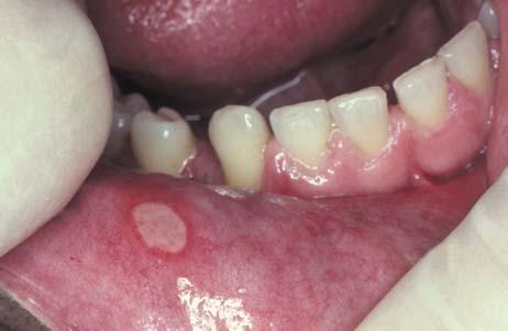 Tx of aphthous ulcers: topical corticosteroid gels Rx: