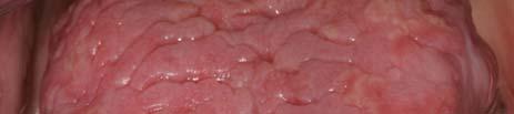Erythema migrans Primarily affects the tongue ( geographic tongue, benign migratory glossitis
