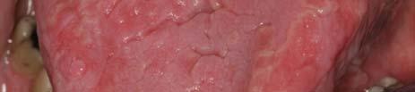 asymptomatic Multiple lesions are usually present Zones of erythema surrounded by a