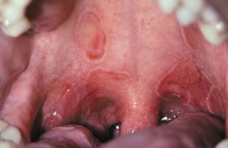 posterior buccal mucosa/vestibule Other locations: Gingiva, lip, tongue Characteristic