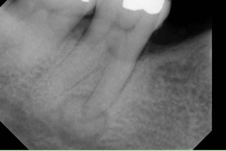 of cases) Anterior mandible, periapical region Usually multiple lesions Asymptomatic Early