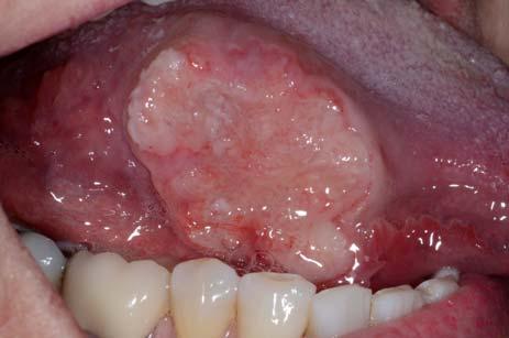with any identifiable risk factors Oral cavity SCC Clinical features Risk increases with age, Males > Females (2.